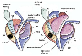 uroloske-bolesti-manji-karcinom-prostate