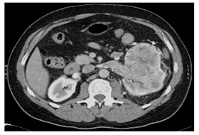 uroloske-bolesti-veliki-tumor-levog-bubrega